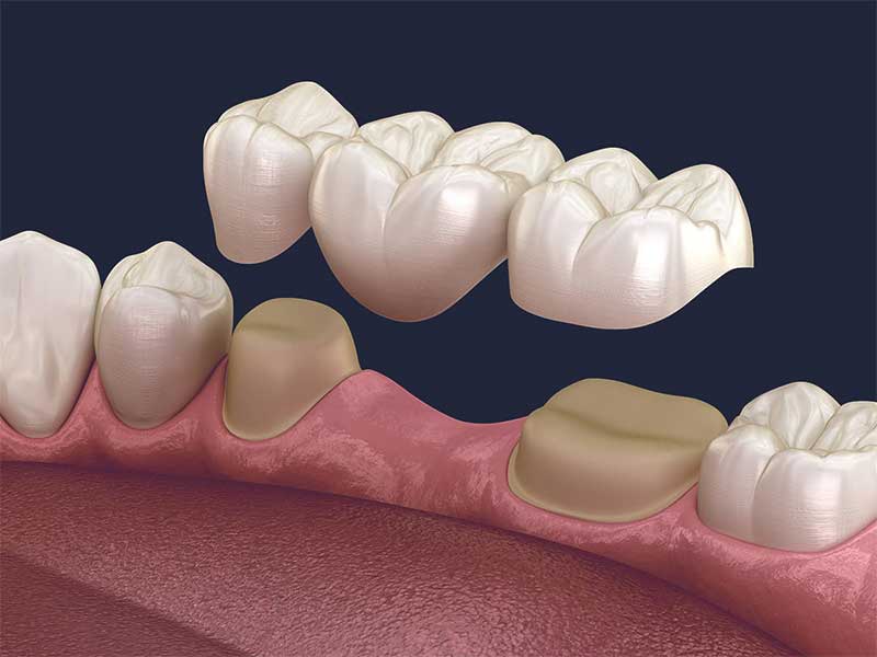 ما هو البريدج و ما هي استخداماته ف طب الأسنان